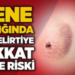 Kene ısırığında bu belirtiye dikkat: Lyme riski