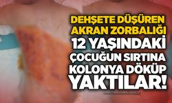 Dehşete düşüren akran zorbalığı: 12 yaşındaki çocuğun sırtına kolonya döküp yaktılar!