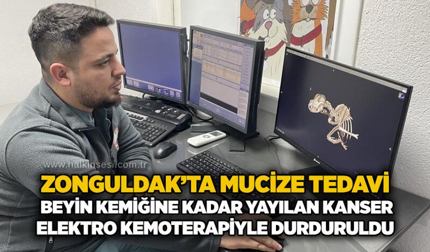 Zonguldak’ta mucize tedavi: Beyin kemiğine kadar yayılan kanser elektro kemoterapiyle durduruldu