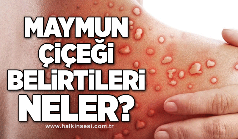 Maymun çiçeği belirtileri neler?